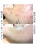 【韓国式肌質改善2ヶ月チャレンジ】肌の免疫力UP!毛穴レスのツヤ肌キープ！