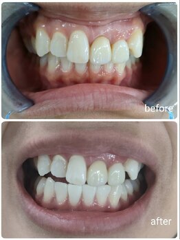 エクシアホワイトニング 新白河店/ホワイトニングビフォーアフター