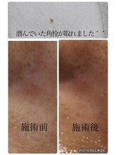 ブーチ 本八幡( BUHTI)/毛穴洗浄/フェイシャル