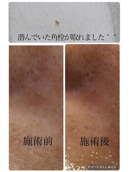 ブーチ 本八幡( BUHTI)/毛穴洗浄/フェイシャル