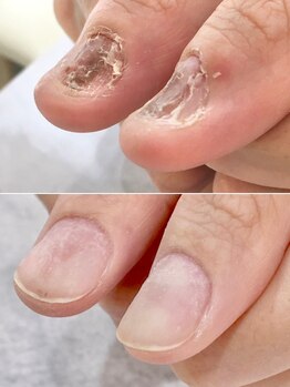 リファーレ(RIFARE)/【深爪矯正経過途中】衝撃の変化