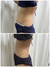 アスピリア(aspirer a')/全身痩身◎