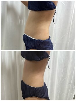 アスピリア(aspirer a')/全身痩身◎