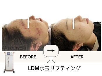 ビューティーワン(Beautyone)/WELLCOMET 正規 LDM