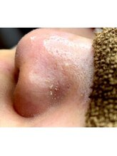 エミルカ 鹿児島店(EMILUCA)/毛穴ケア