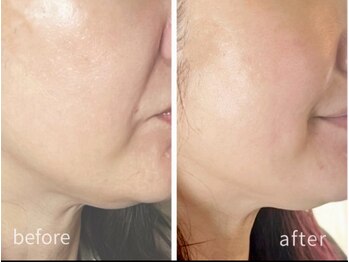 ロジワール(LOISIR)/フェイスラインが上がる