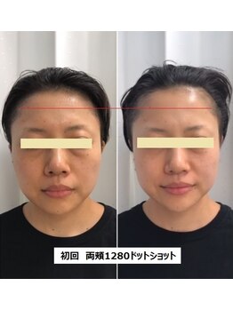 ナチュレアンドメディカ(Nature&Medica)/【たるみor小顔】ウルトラリフト