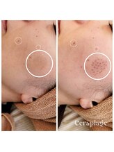 セラピエージ/隠れシミ発見！