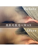 エピナ 横浜店(Epina)/うなじMIX脱毛☆