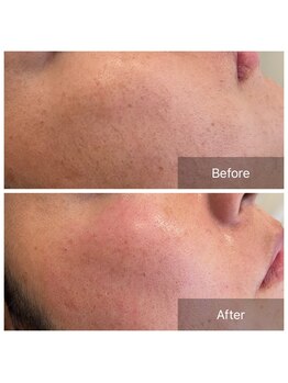 ライエ(Raie)/フェイスワックス脱毛