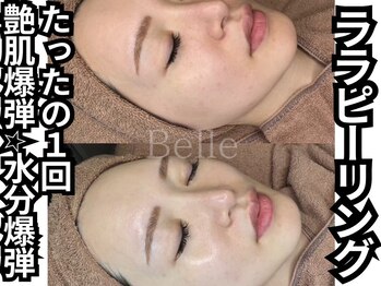 ベル 南船場店(Belle)/ララピーリング1回
