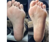足裏の角質ケアで、ふわもちかかとを目指しましょう(*^^*)