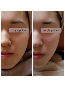 ロージーハピネス(Rosy happiness)/顔の歪み