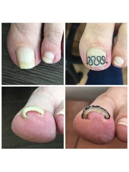 事例【ツメフラ法巻き爪矯正】