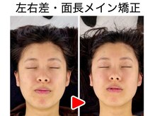 エレヴィザ トウキョウ 恵比寿院(ELVISA TOKYO)/左右差・面長改善 /　初回施術