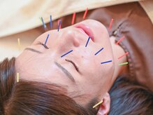 すばる屋/美容鍼でリストアップ