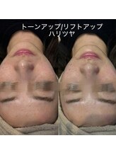 #美容革命ラボ 大阪南堀江店/毛穴洗浄・プラズマシャワー