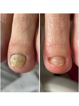 チェンジ(CHANGE)/変形爪