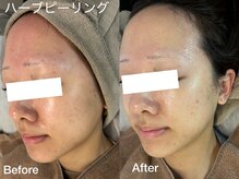 プティ 横浜店(Petit)/ハーブピーリング+幹細胞パック