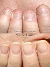 マリーロール 梅田店(Marie Laure)/自爪育成/深爪矯正/ネイルケア