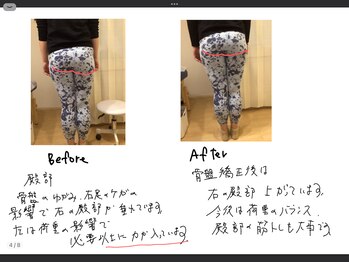 しろねこ整体院/ビフォーアフターお尻の崩れ