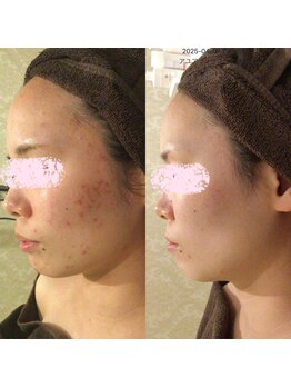 アユアランリンク 札幌店/20代後半/肌質改善/約2年