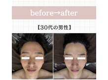 ジェイド(Jade)/初回のbefore→after