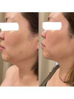 ポポラス(POPOLUS)/首ケアコース1回