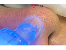 【ハイドラフェイシャルへのこだわり】水流ピーリングで毛穴スッキリ＆潤いチャージ