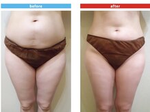 ビューティ ケア ルーム メロウ(Beauty Care Room Moelleux)/痩身before&after