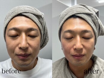 スキンラボ ドットシキブ 厚木海老名店(skinlabo .sikibu)/メンズ小顔シェイプサーモ