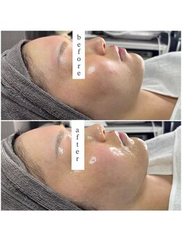 レイ(Rey)/20代のお客様施術1回 赤み悩み