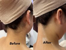 クイーン(QUEEN)/脱毛当日シェービングOK