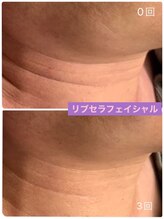 プリュネル(Prunelle)/プラズマシャワー