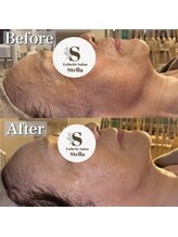 ステラ(Stella)/ビタミン導入