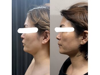 アイアム(I am)/ハイリフトBefore after