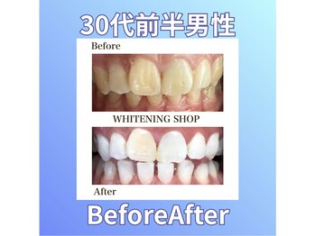ホワイトニングショップ 西原店/30代前半男性☆ビフォーアフター