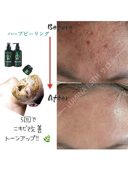 ルミナエステ(LUMINA ESTH)/ハーブピーリング/川口