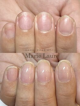 マリーロール 淀屋橋本店(Marie Laure)/深爪矯正/自爪風/自爪育成