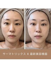リム ビューティー(RYM BEAUTY)/サーマ＋最新小顔超音波