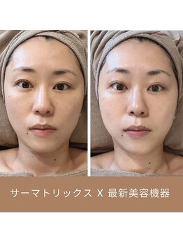 リム ビューティー(RYM BEAUTY)/サーマ+最新小顔超音波