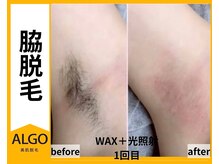 アルゴ 山口宇部店(ALGO)/即日！脇脱毛+WAX