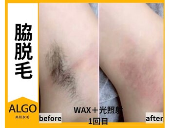 アルゴ 山口宇部店(ALGO)/即日！脇脱毛+WAX