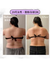 グランディールアン(GRANDIR UN)/背中冷却2回