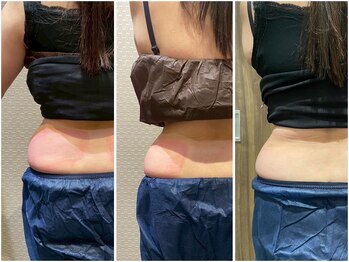 ビュウナ 銀座(BEAUNA)/脂肪冷却/frozen8