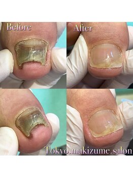 巻き爪補正店 越谷店/変形爪補正