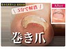 【巻き爪世界大会採用技術◎強く巻いた爪に ワイヤー矯正 親指1本】¥12,000