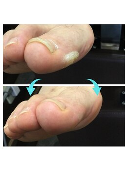 ネイルメディックス 宇都宮店の写真/足底・足趾にできたタコ魚の目をソフトでツルツルに♪プロのケアで健康的な足裏へ導く。