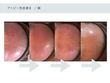 アーブル(Agreable)/額/炎症肌