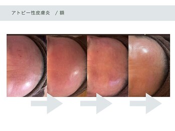 アーブル(Agreable)/額/炎症肌